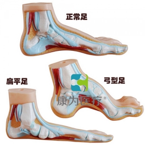 “康為醫(yī)療”正常足、扁平足、弓型足模型