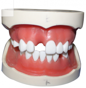 種植牙模型（含上、下頜）